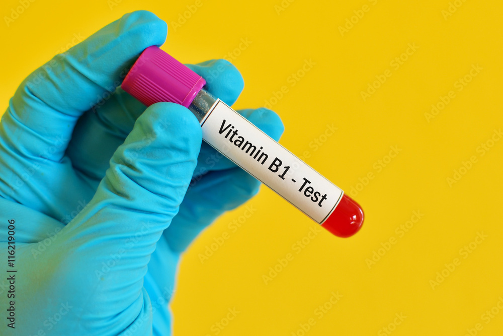 Obraz premium Test tube with blood sample for vitamin B1 test
