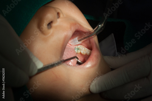 Dentists using the tool dental children, sealant.