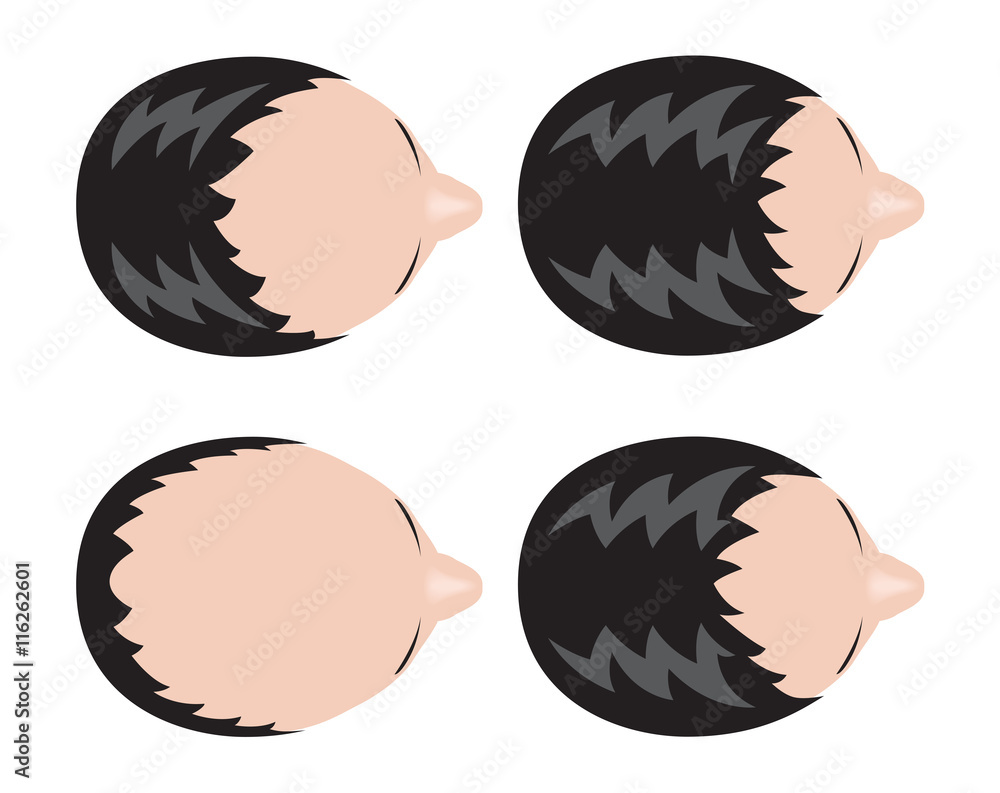 Φωτογραφία Stages of hair loss . bald man . no hair
