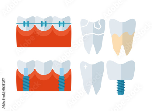 Tooth implant vector illustration. Tooth implant vector isolated on white background. Tooth implant vector icon illustration. Tooth implant vector isolated vector