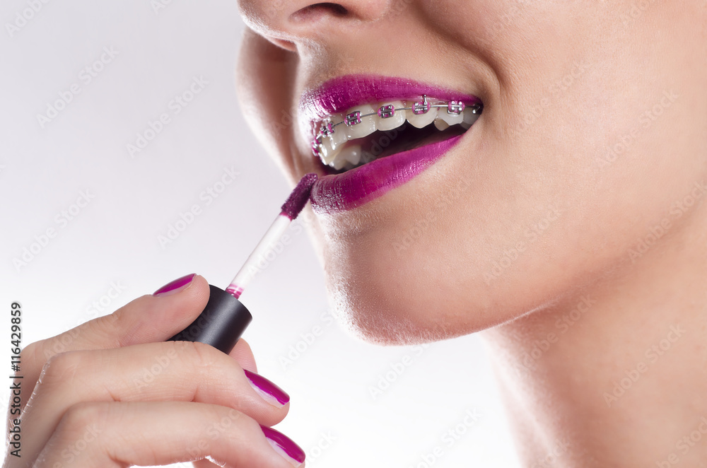 Closeup of woman with braces applying lip gloss
