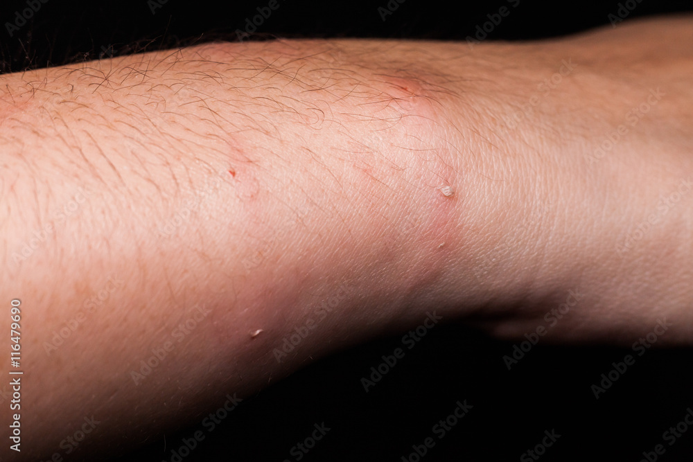 Dog bite wound and scar with grey background Dog bite wound and scar with grey background