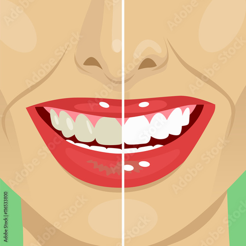 Perfect smile before and after bleaching. Dental care and whitening teeth