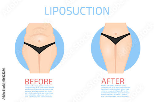 Liposuction before and after infographics