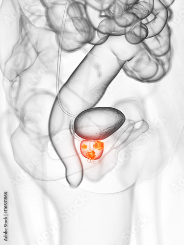 3d rendered medically accurate illustration of prostate cancer