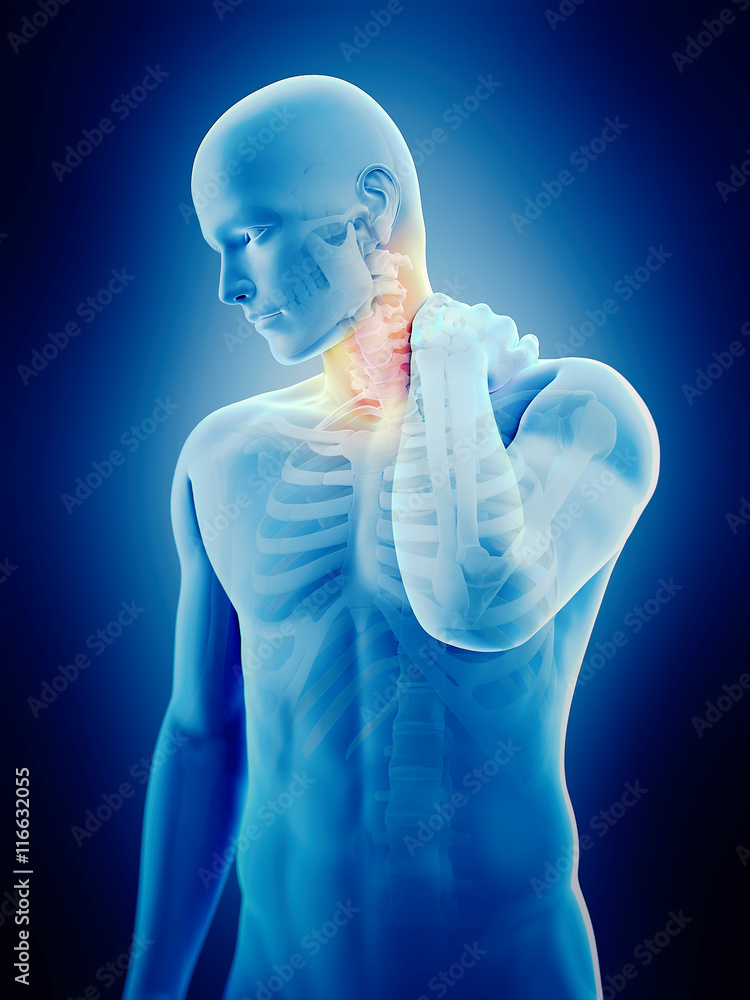 medically accurate 3d illustration of neck pain medically accurate 3d illustration of neck pain