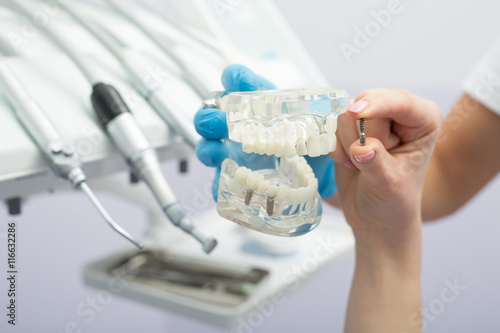 Implant teeth model
