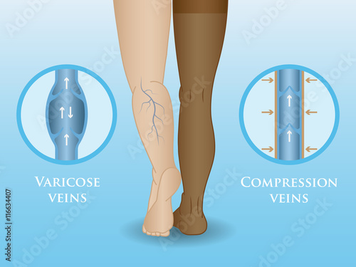 Medical compression hosiery