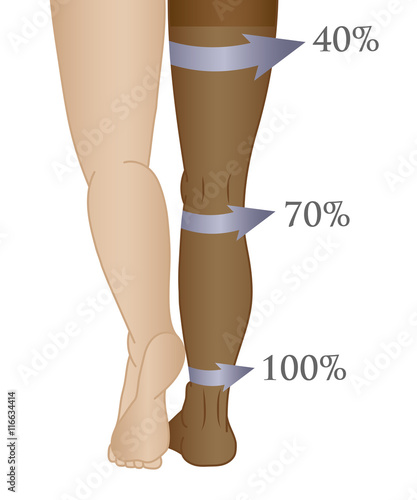 Medical compression hosiery