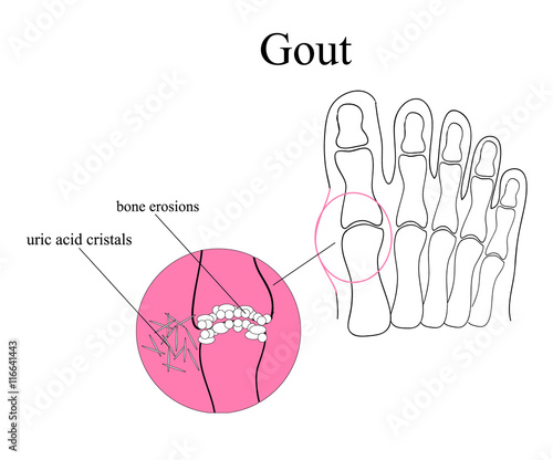 Diagram of gout in human toe illustration