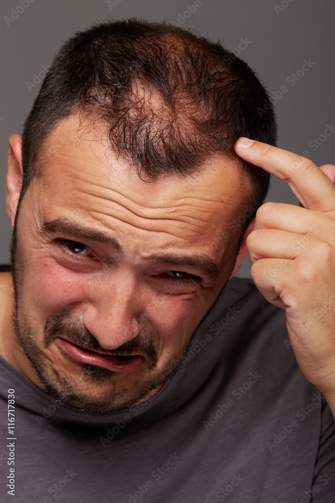 Obraz premium alopecia