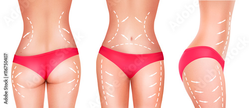 Lines, showing surgery on female body. Vector.