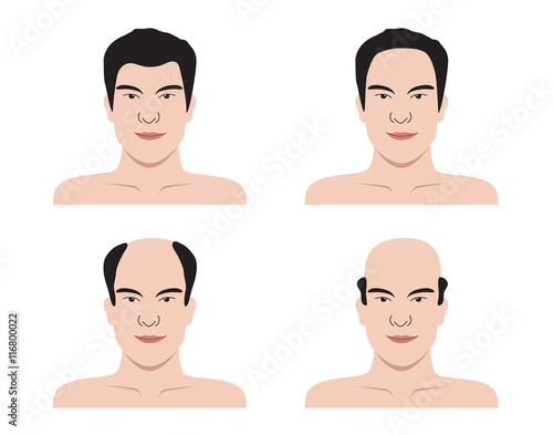 Stages of hair loss . bald man . no hair