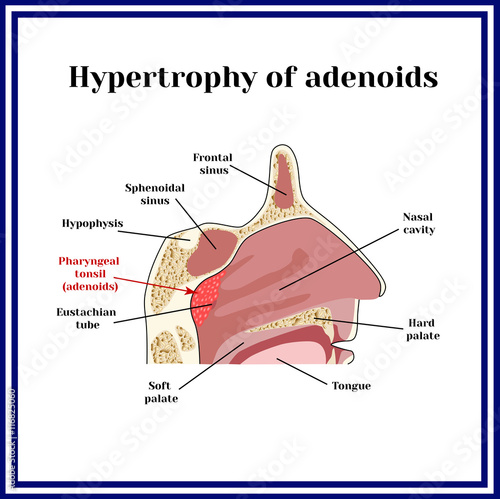 Location of adenoids.The structure of the nasopharynx. Hypertrophy of adenoids. photo