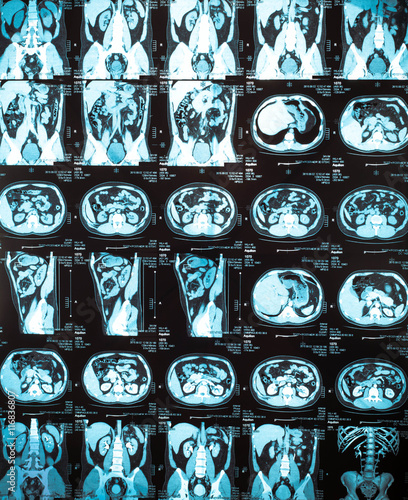 Kidney magnetic resonance image