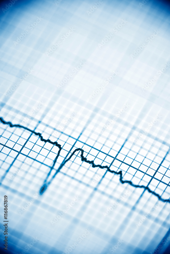 Electrocardiogram Electrocardiogram