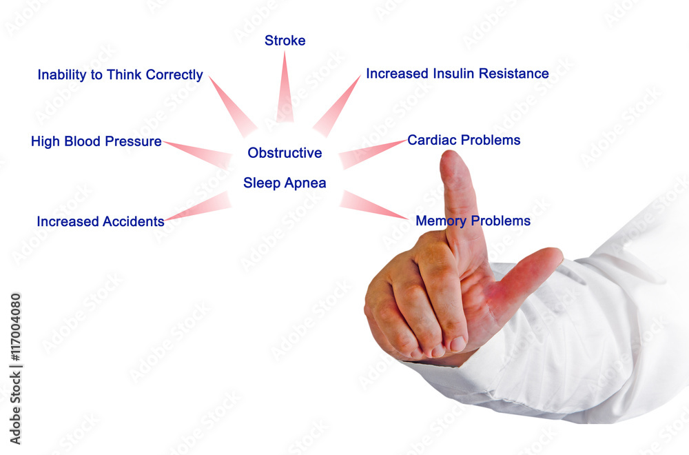 Obstructive Sleep Apnea Obstructive Sleep Apnea