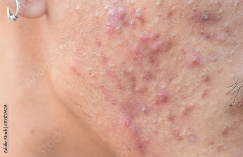 Man with problematic skin and scars from acne  scar 