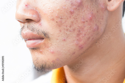 man with problematic skin and scars from acne (scar) photo