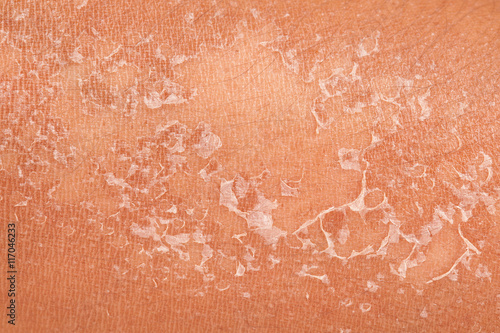 peeling of skin after burned by sunlight