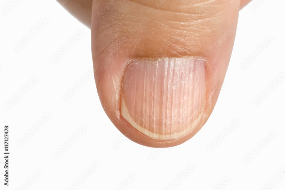 Vertical ridges on the fingernails symptoms deficiency vitamins Stock