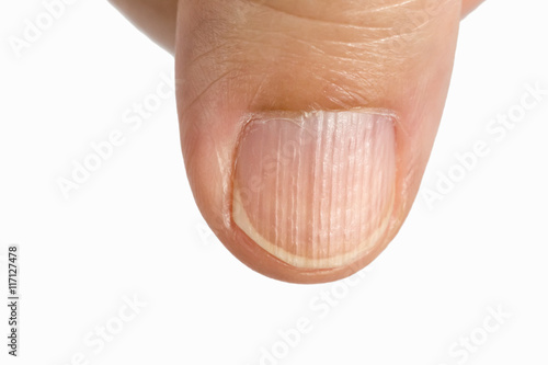 Vertical ridges on the fingernails symptoms deficiency  vitamins photo