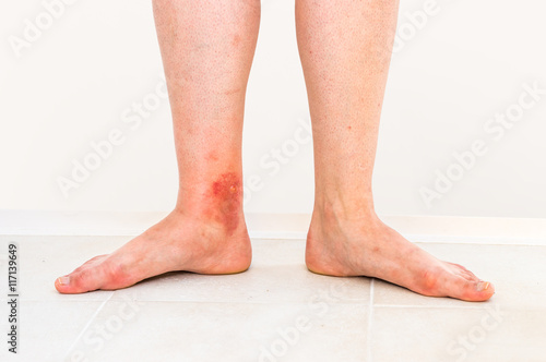 Red rash on leg of patient who was bitten by an insect © andriano_cz