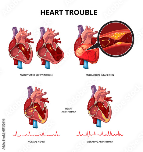 Heart disease vector infographics