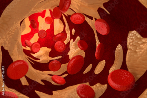 Arteriosclerosis by Cholesterol Plaque, 3D Rendering photo