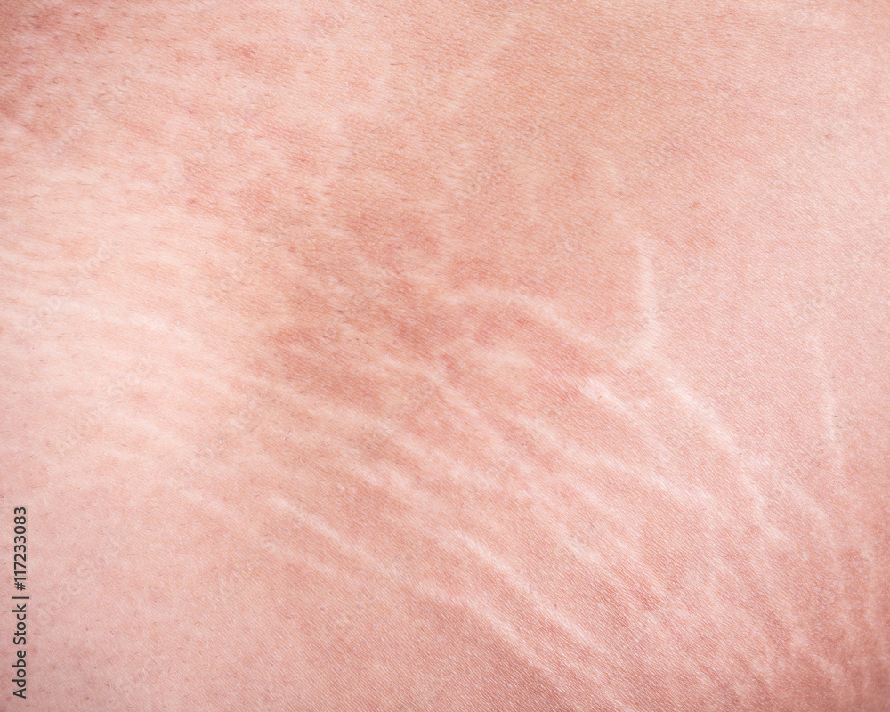 Stretch marks of skin on the thigh