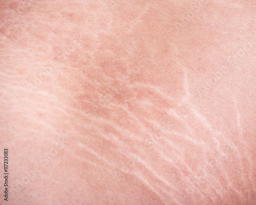 Stretch marks of skin on the thigh