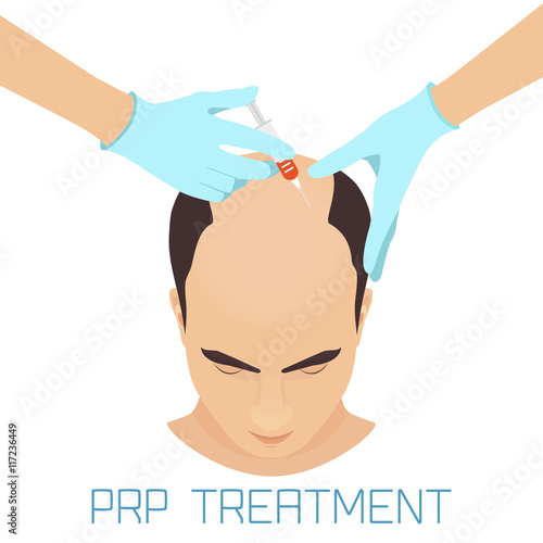Platelet rich plasma injection procedure for balding men. PRP treatment process. Male hair loss treatment infographics. Meso therapy. Hair growth stimulation. Vector illustration.