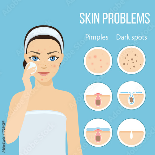 Girl cleans her face with cosmetic lotion. Skin problems solution, home remedies. Vector stock illustration.