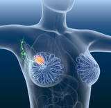 Breast cancer, lymphatics, mastocarcinoma