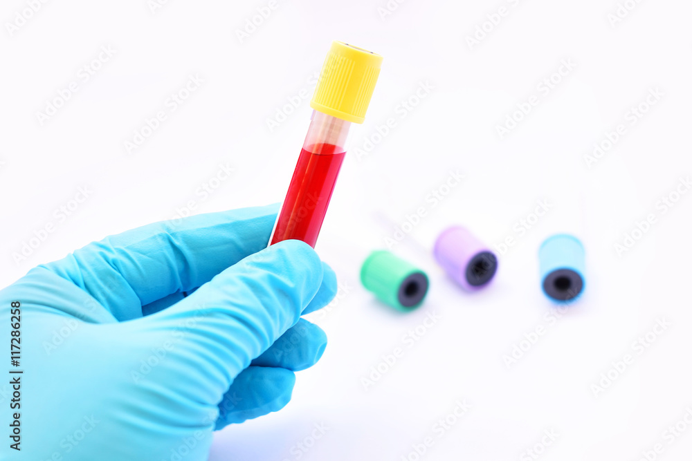 Blood sample for laboratory testing
Blood sample for laboratory testing