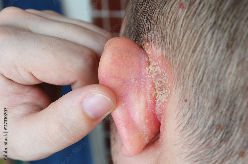 Naklejka premium Psoriasis behind the ear, psoriasis on the nails, pushes the ear, dermatological problems, skin diseases