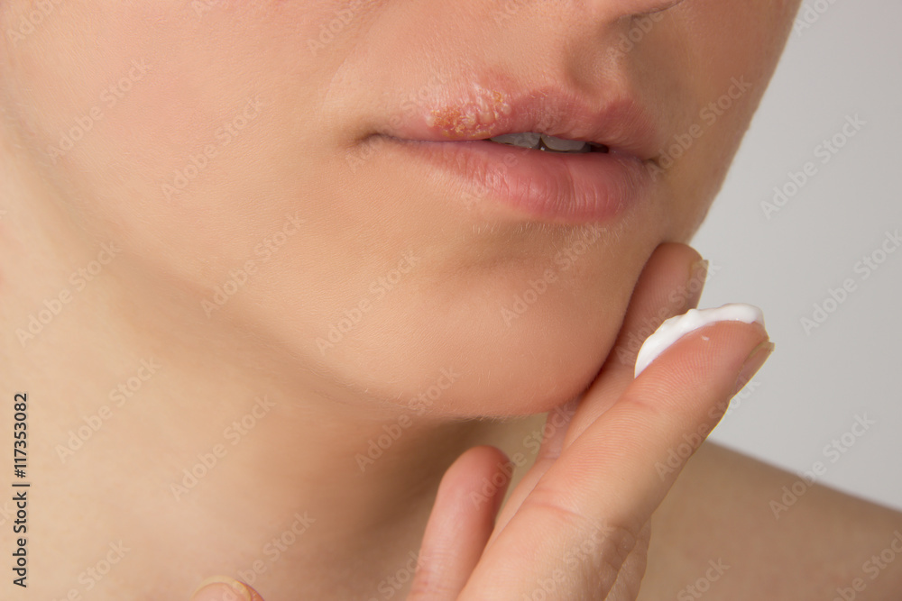 Herpes sore with pus on the lips of the young beautiful girl and Herpes sore with pus on the lips of the young beautiful girl and