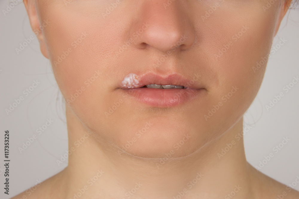 Obraz premium Herpes sore with pus on the lips of the young beautiful girl and