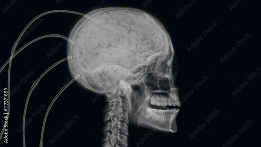 X-ray of experimental procedure on human brain. X-ray of experimental procedure on human brain.
