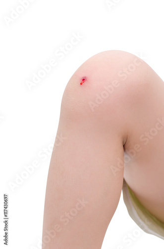 boy 's knee with wound