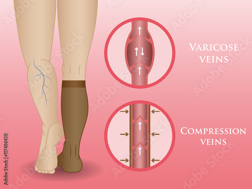 Medical compression hosiery
