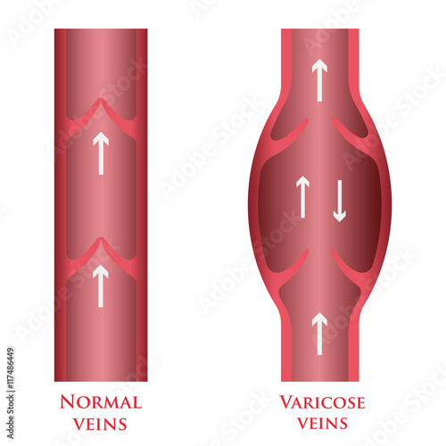 vector varicose veins