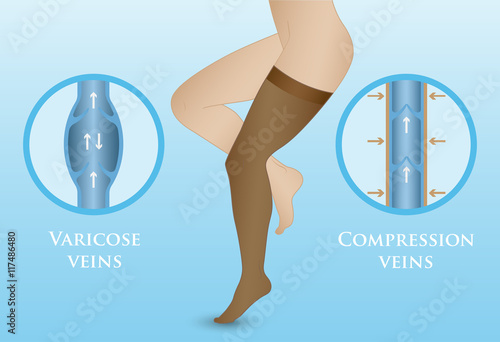 Medical compression hosiery