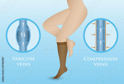 Medical compression hosiery
