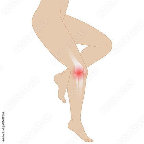 Vector illustration arthritis