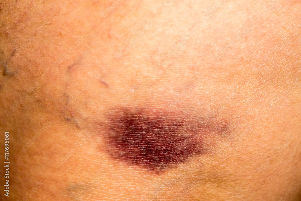 Fototapeta premium Bruise on Skin