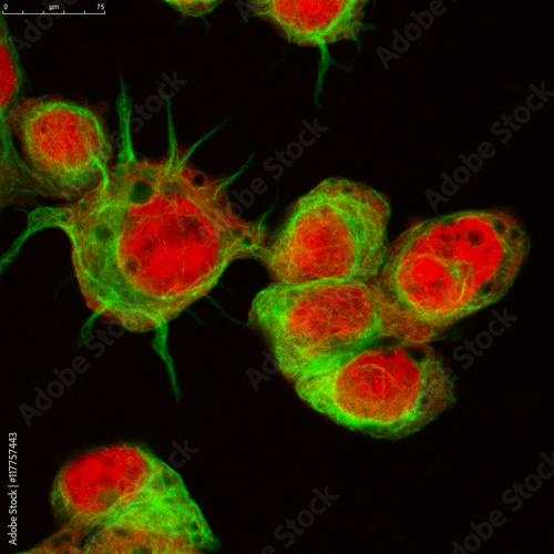 Real fluorescence microscopic view of human neuroblastoma cells