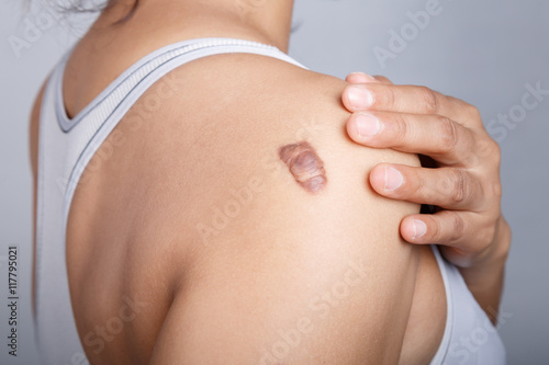 Fototapeta Scar on human skin
