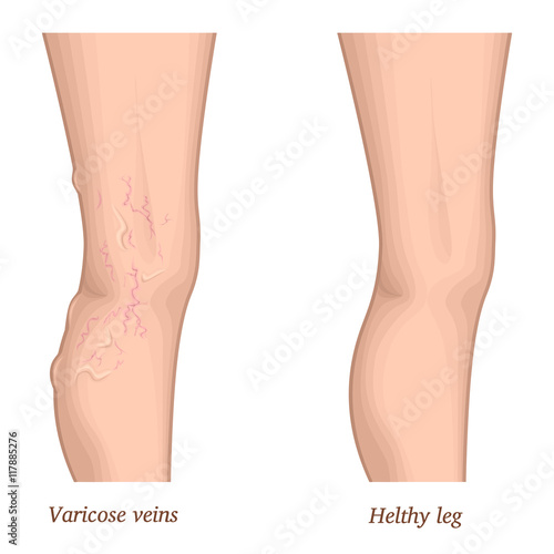 Illustration of a healthy leg and the affected varicose veins