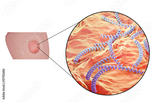 Foto Syphilitic ulcer ulcus durum and close-up view of syphilis bacteria Treponema pa
